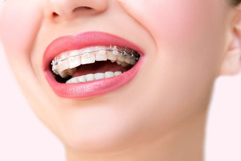 آیا ارتودنسی فقط برای زیبایی است؟ کاربردهای درمانی ارتودنسی را بشناسید