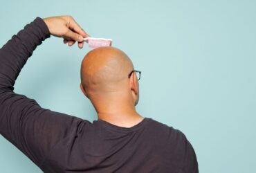 روشی نوین برای مقابله با طاسی؛ بوتاکس جدید در درمان ریزش مو