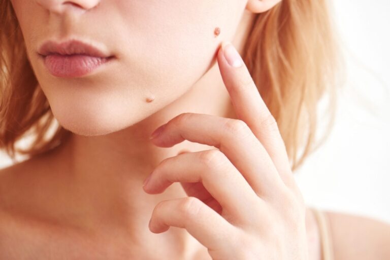 تفاوت خال گوشتی و زگیل و خطرات روش‌ های غیرعلمی برداشتن آنها