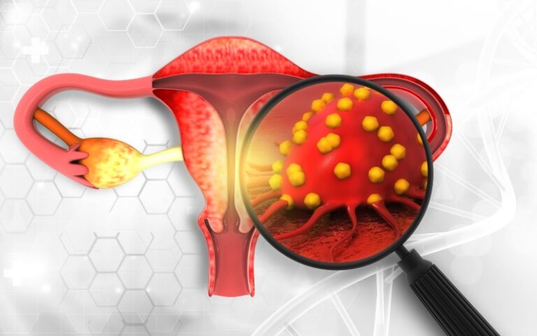 مولکول F2R؛ کلید امیدبخش در تشخیص زودهنگام و درمان هدفمند سرطان تخمدان