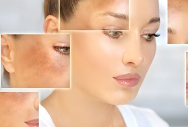 عوامل موثر بر تیرگی پوست + راهکارهای شفاف‌ سازی و رفع لکه ها