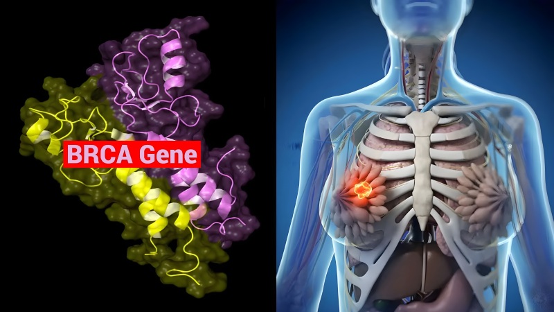 ژن BRCA چیست و چرا اهمیت دارد؟