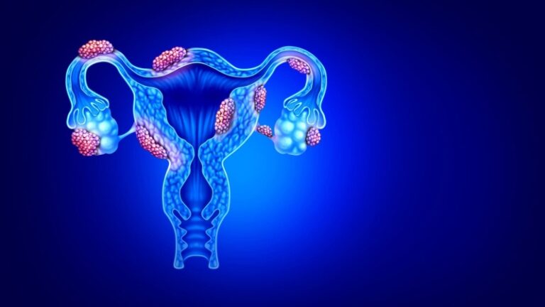 آندومتریوز و دیابت نوع ۲؛ آیا آندومتریوز خطر ابتلا به دیابت را افزایش می دهد؟