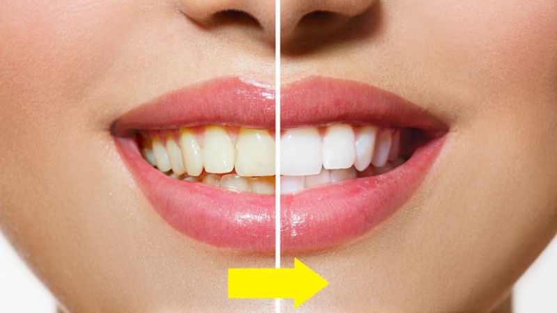 چگونه از زرد شدن کامپوزیت جلوگیری کنیم؟